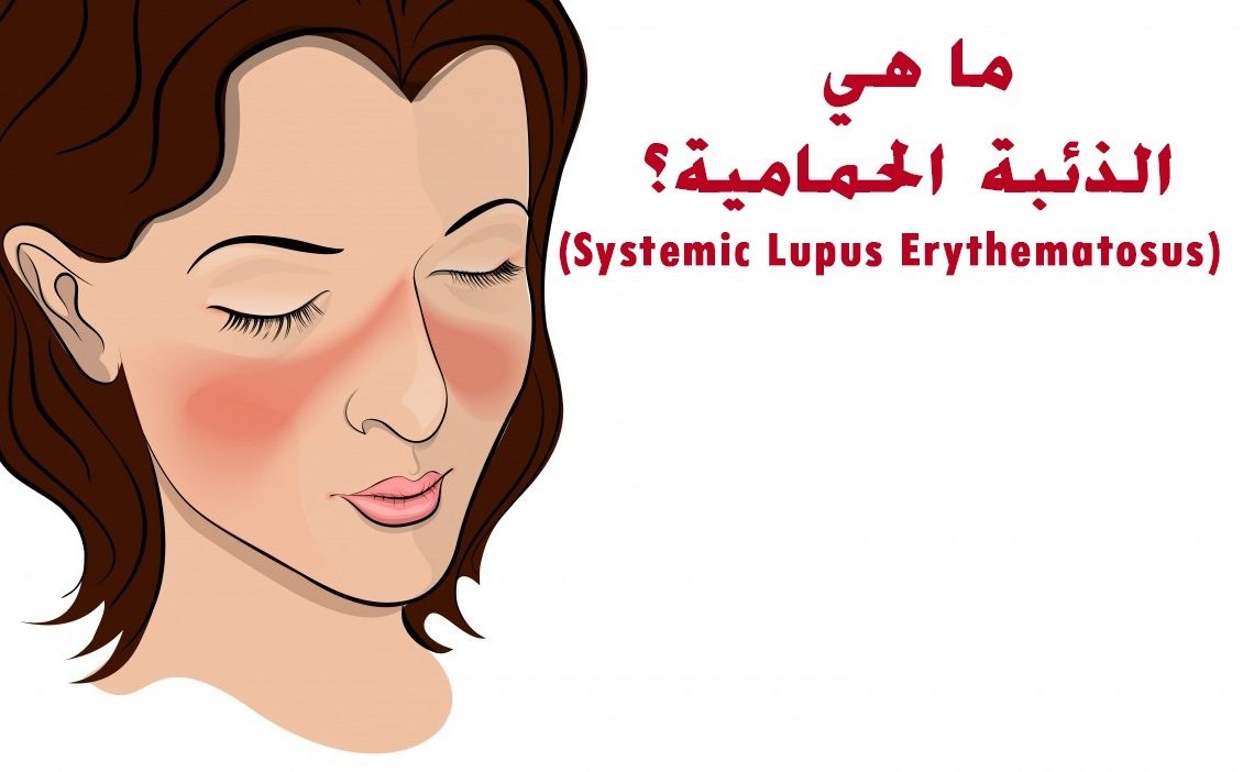 Lupus Erythematosus.
