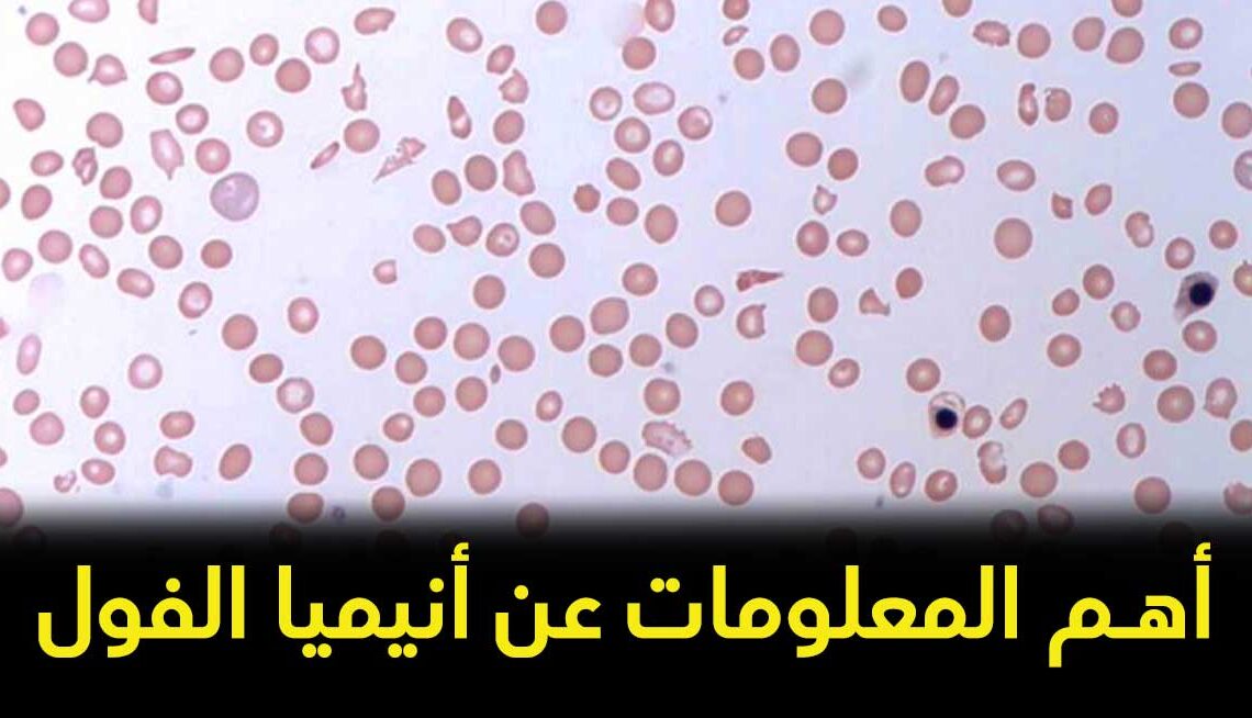 أهم المعلومات عن فقر الدم الفولي