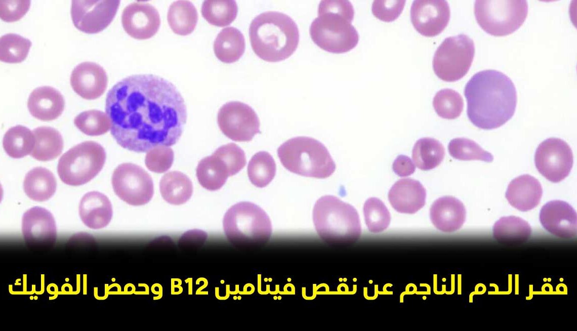 فقر الدم الناجم عن نقص فيتامين B12 وحمض الفوليك