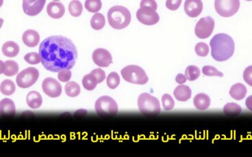 فقر الدم الناجم عن نقص فيتامين B12 وحمض الفوليك